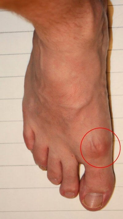 Bone Spur, Bunion, or Gouty Tophus photo?