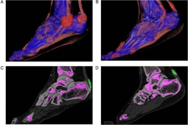 Gout in Ankle scan